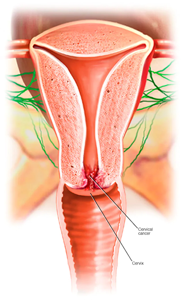 Cervical Cancer