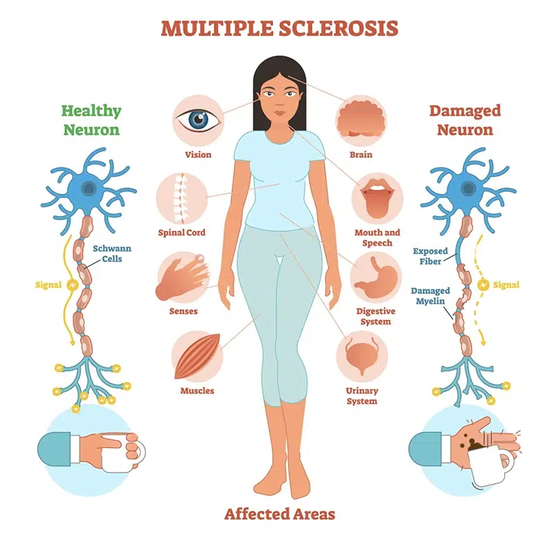 Mes de Concienciación Sobre La Esclerosis Múltiple: ¿Qué Es La EM? 2 Symptoms 2