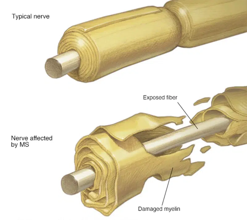 Multiple Sclerosis Awareness Month: What Is Ms? 1 Nerve Affected By Ms