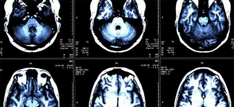 Multiple Sclerosis Awareness Month: What Is Ms? 3 Treatment